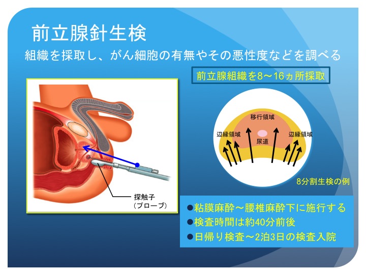 前立腺がんは予防可能ですか?
